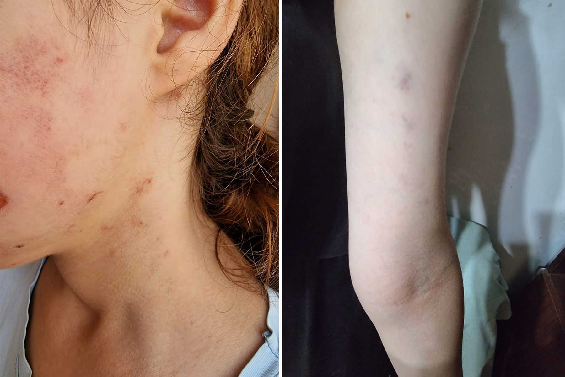 Photos of injuries allegedly sustained by the girl were posted online by children’s rights activist Kamala Aghazade.