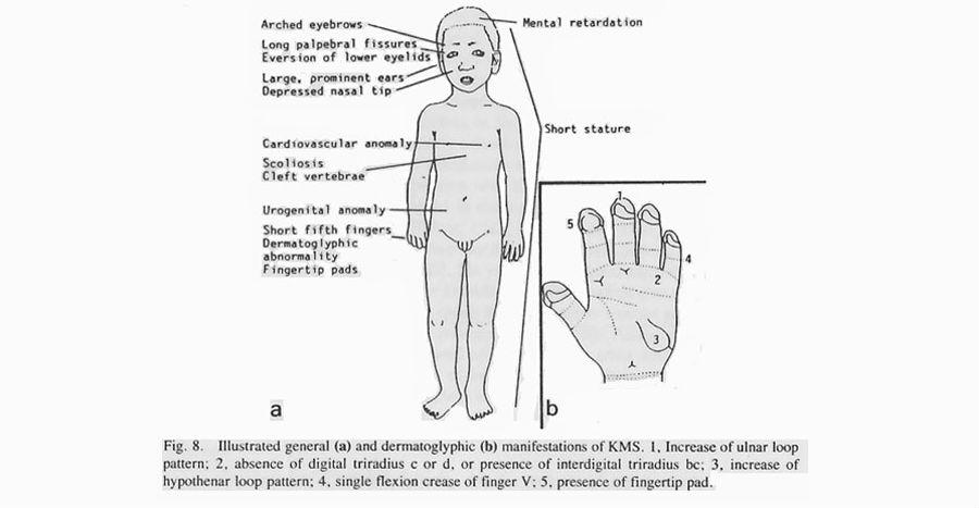 Patients with rare genetic diseases in Daghestan need help