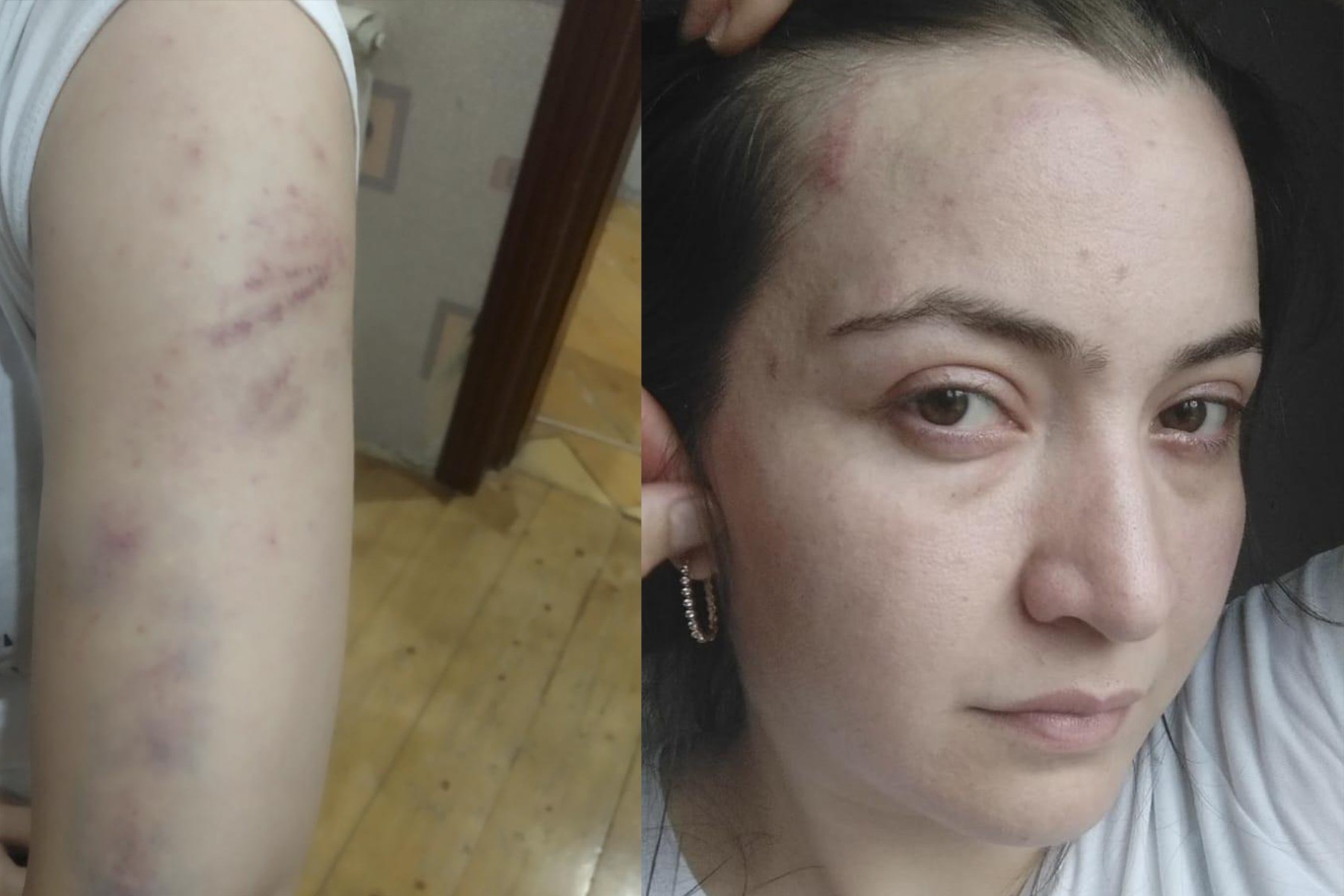 Khanim Mammadova and her injuries. Photos via report.az.