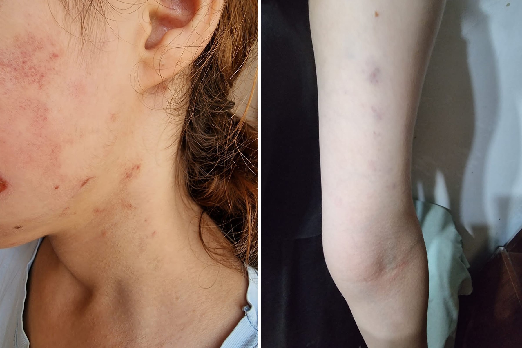 Photos of injuries allegedly sustained by the girl were posted online by children’s rights activist Kamala Aghazade.