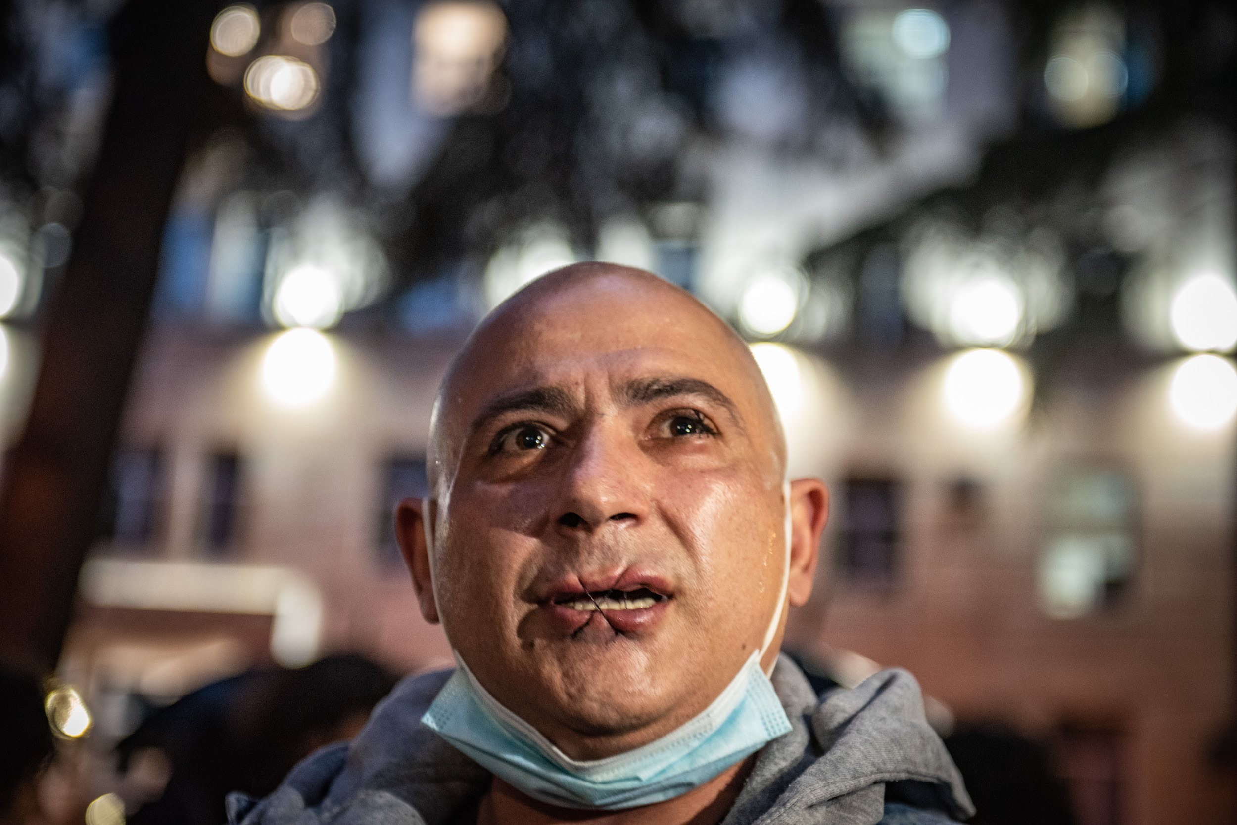Beka Grigoriadis after having sewn his eye and lips shut. Photo: Mariam Nikuradze/OC Media.